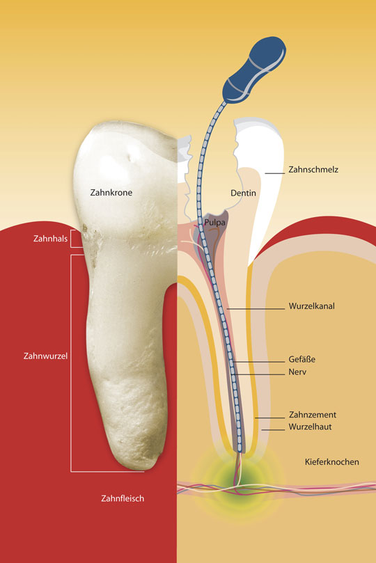 Wurzelkanalbehandlung Zahnarzte Bellmann